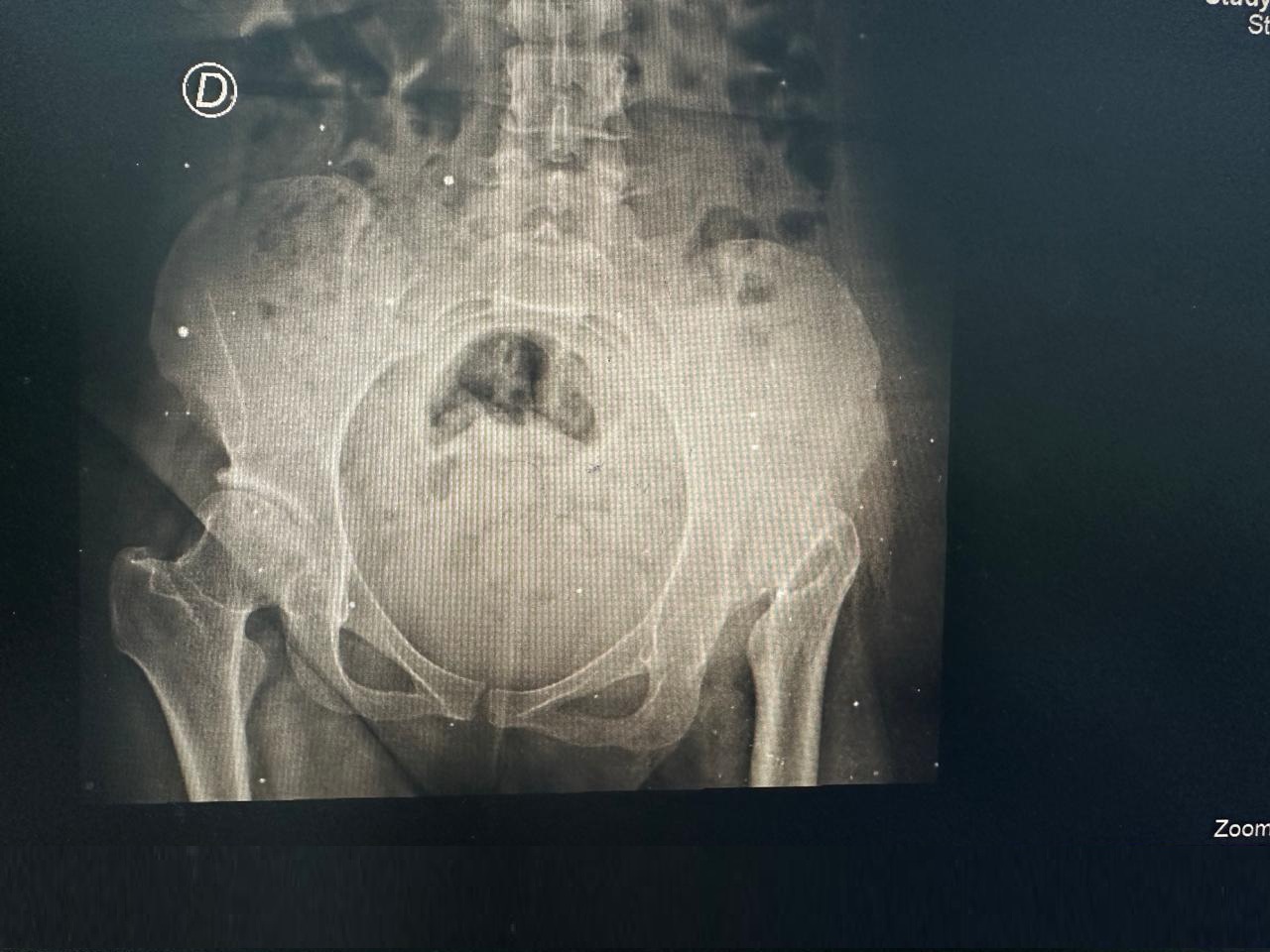 Radiografía Preoperatoria Cadera